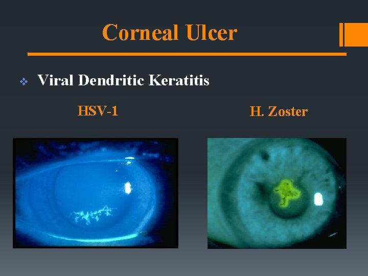 Corneal Ulcer v Viral Dendritic Keratitis HSV-1 H. Zoster 