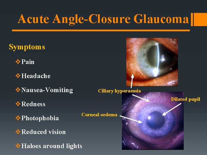 Acute Angle-Closure Glaucoma Symptoms v. Pain v. Headache v. Nausea-Vomiting Ciliary hyperaemia Dilated pupil