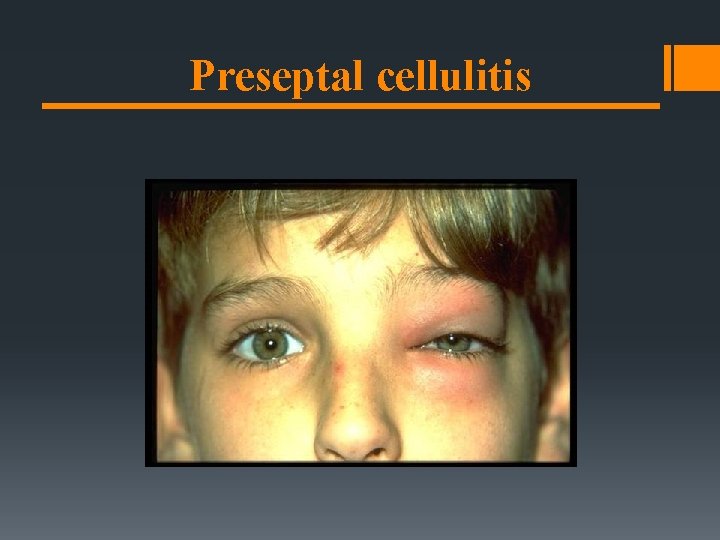 Preseptal cellulitis 