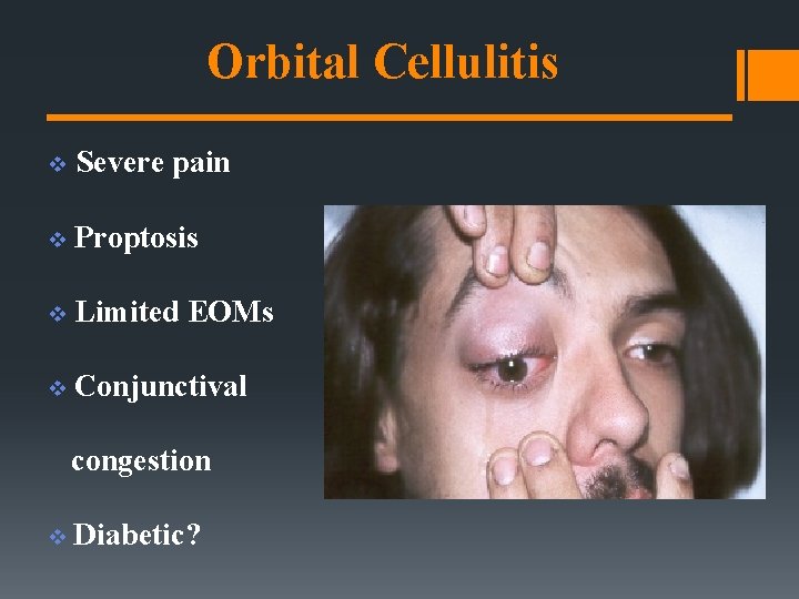 Orbital Cellulitis v Severe pain v Proptosis v Limited EOMs v Conjunctival congestion v