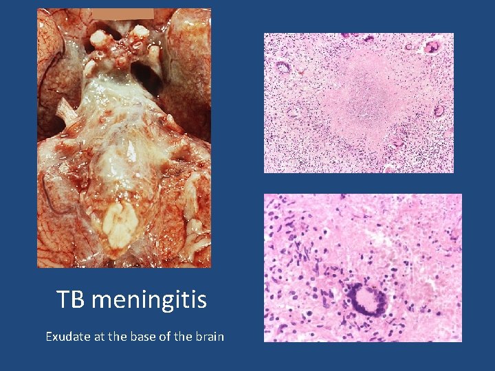 TB meningitis Exudate at the base of the brain 