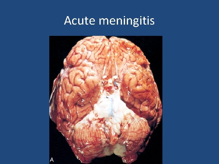Acute meningitis 