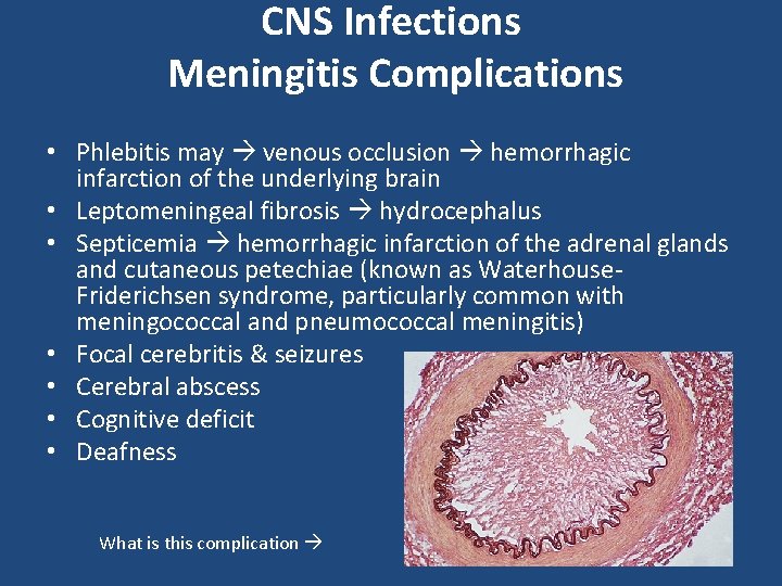 CNS Infections Meningitis Complications • Phlebitis may venous occlusion hemorrhagic infarction of the underlying