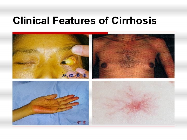 Clinical Features of Cirrhosis 
