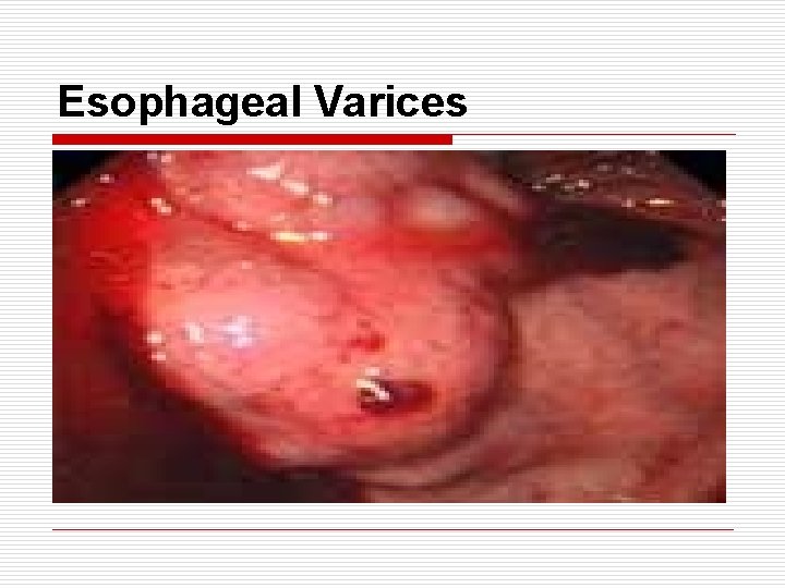 Esophageal Varices 