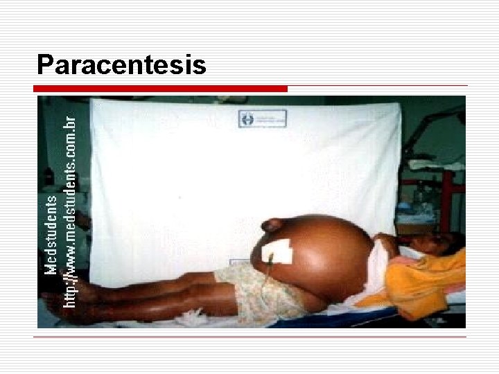 Paracentesis 