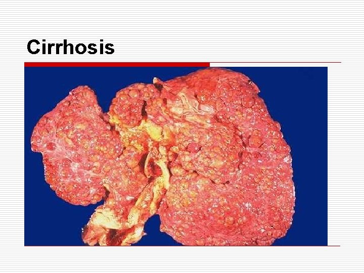 Cirrhosis 