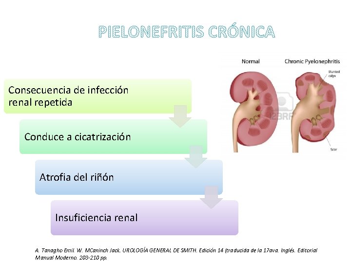 Consecuencia de infección renal repetida Conduce a cicatrización Atrofia del riñón Insuficiencia renal A.