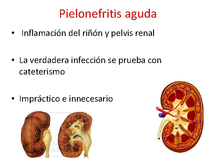 Pielonefritis aguda • Inflamación del riñón y pelvis renal • La verdadera infección se