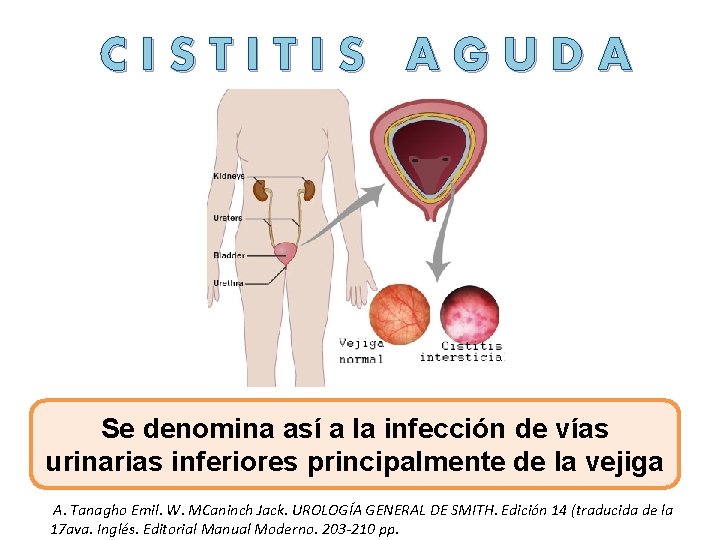 CISTITIS AGUDA Se denomina así a la infección de vías urinarias inferiores principalmente de