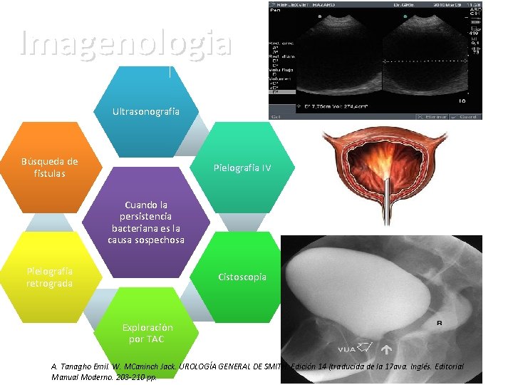 Imagenologia Ultrasonografia Búsqueda de fistulas Pielografia IV Cuando la persistencia bacteriana es la causa