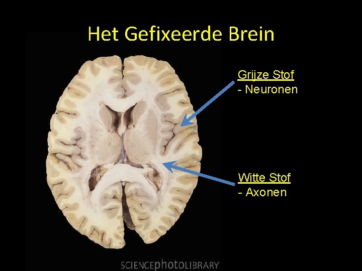 Het Gefixeerde Brein Grijze Stof - Neuronen Witte Stof - Axonen 