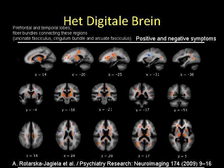 Het Digitale Brein Prefrontal and temporal lobes, fiber bundles connecting these regions (uncinate fasciculus,