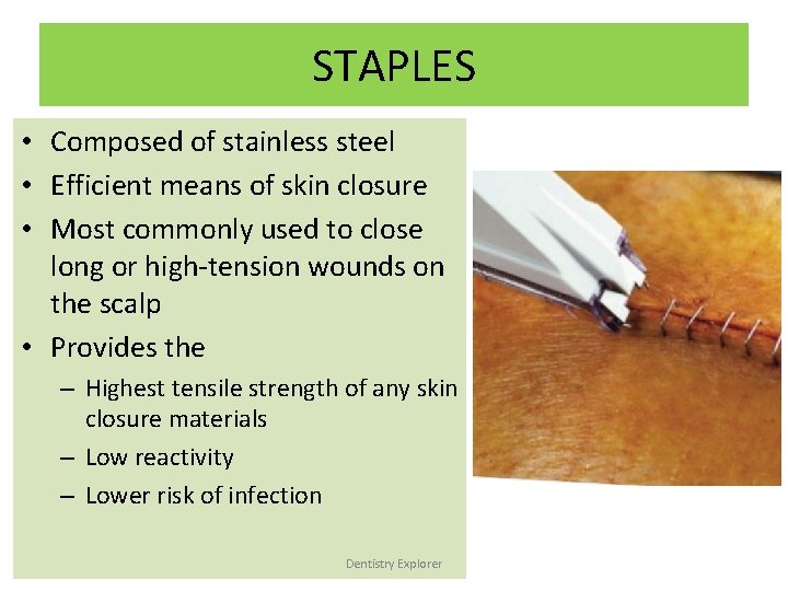 STAPLES • Composed of stainless steel • Efficient means of skin closure • Most