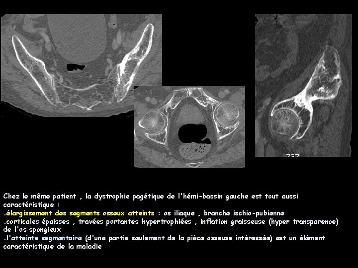 Chez le même patient , la dystrophie pagétique de l'hémi-bassin gauche est tout aussi