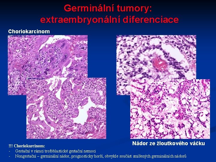 Germinální tumory: extraembryonální diferenciace Choriokarcinom Nádor ze žloutkového váčku !!! Choriokarcinom: - Gestační v