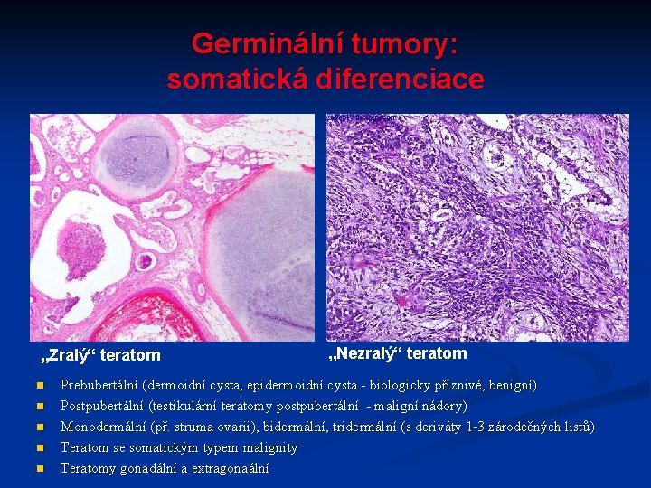 Germinální tumory: somatická diferenciace „Zralý“ teratom n n n „Nezralý“ teratom Prebubertální (dermoidní cysta,