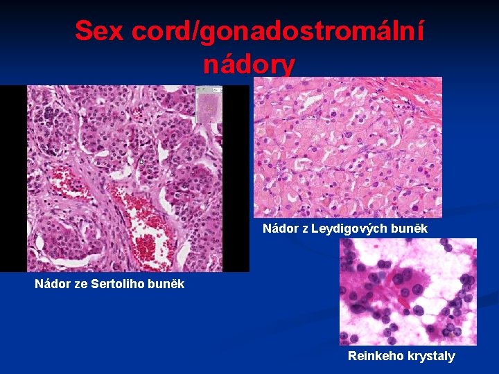 Sex cord/gonadostromální nádory Nádor z Leydigových buněk Nádor ze Sertoliho buněk Reinkeho krystaly 