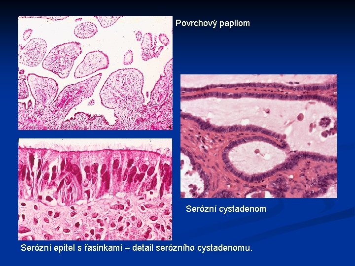 Povrchový papilom Serózní cystadenom Serózní epitel s řasinkami – detail serózního cystadenomu. 