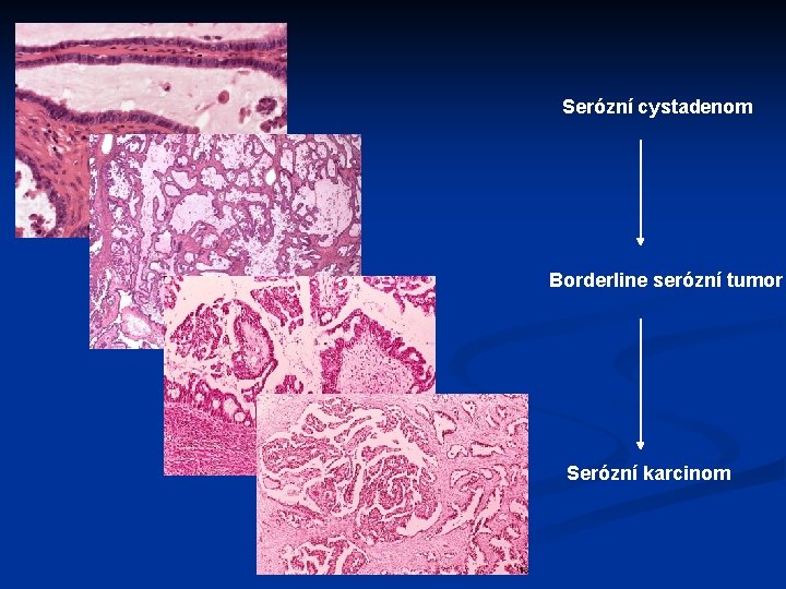 Serózní cystadenom Borderline serózní tumor Serózní karcinom 