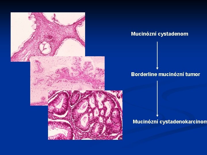 Mucinózní cystadenom Borderline mucinózní tumor Mucinózní cystadenokarcinom 