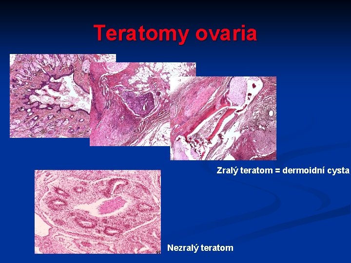 Teratomy ovaria Zralý teratom = dermoidní cysta Nezralý teratom 