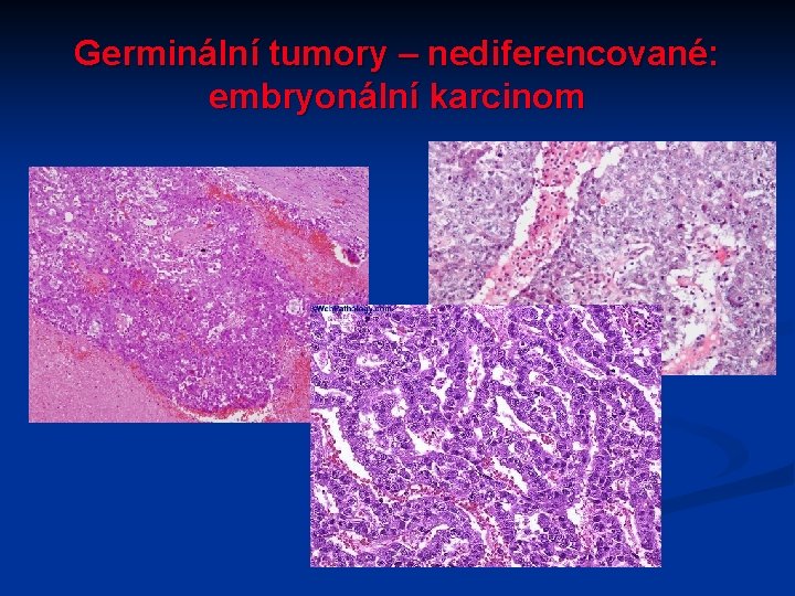 Germinální tumory – nediferencované: embryonální karcinom 