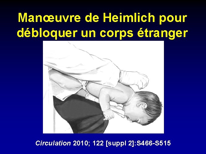 Manœuvre de Heimlich pour débloquer un corps étranger Circulation 2010; 122 [suppl 2]: S