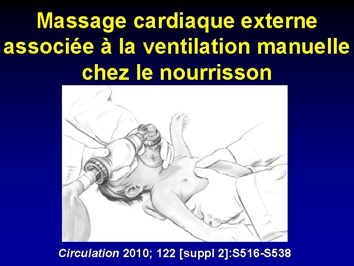 Massage cardiaque externe associée à la ventilation manuelle chez le nourrisson Circulation 2010; 122