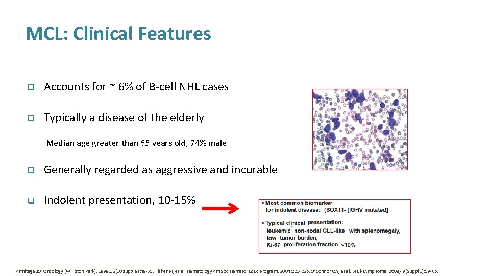 MCL: Clinical Features q Accounts for ~ 6% of B-cell NHL cases q Typically