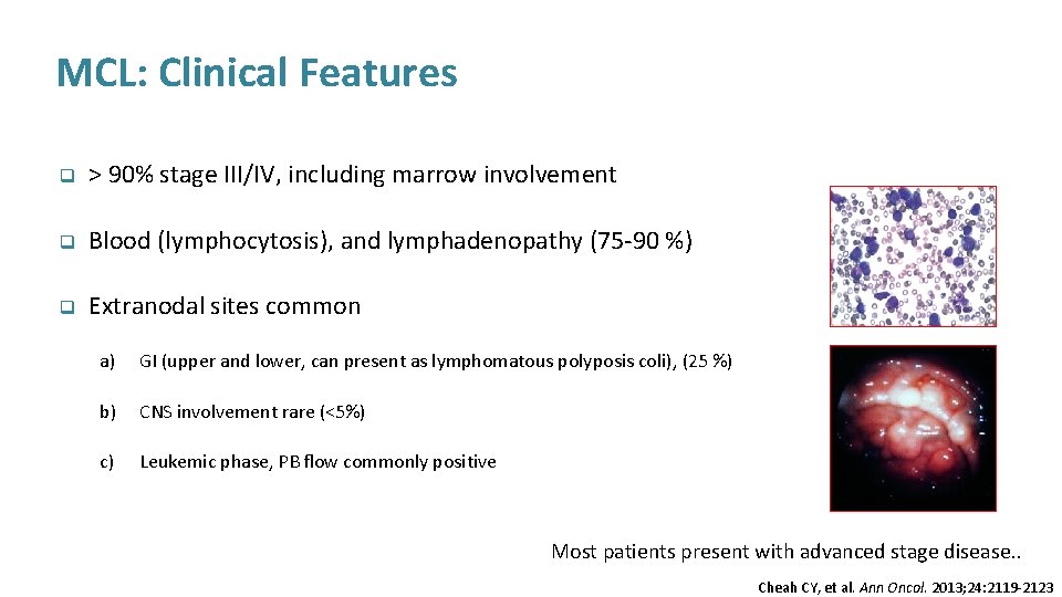 MCL: Clinical Features q > 90% stage III/IV, including marrow involvement q Blood (lymphocytosis),