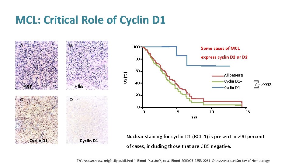 MCL: Critical Role of Cyclin D 1 100 Some cases of MCL express cyclin
