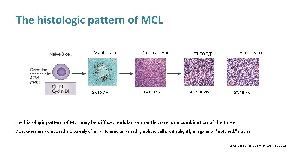 The histologic pattern of MCL Mantle Zone 5% to 7% Nodular type 10% to