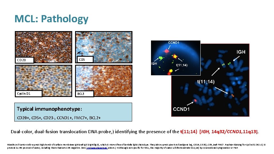 MCL: Pathology CD 20 Cyclin D 1 CD 5 BCL 2 Typical immunophenotype: CD