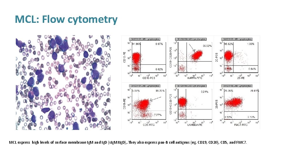 MCL: Flow cytometry MCL express high levels of surface membrane Ig. M and Ig.