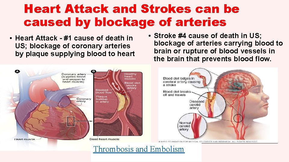 Heart Attack and Strokes can be caused by blockage of arteries • Heart Attack