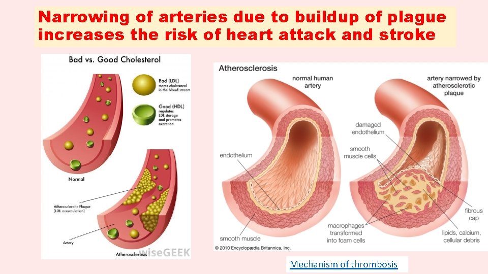 Narrowing of arteries due to buildup of plague increases the risk of heart attack