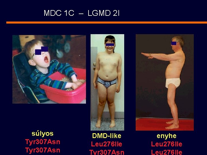 MDC 1 C – LGMD 2 I súlyos Tyr 307 Asn DMD-like Leu 276
