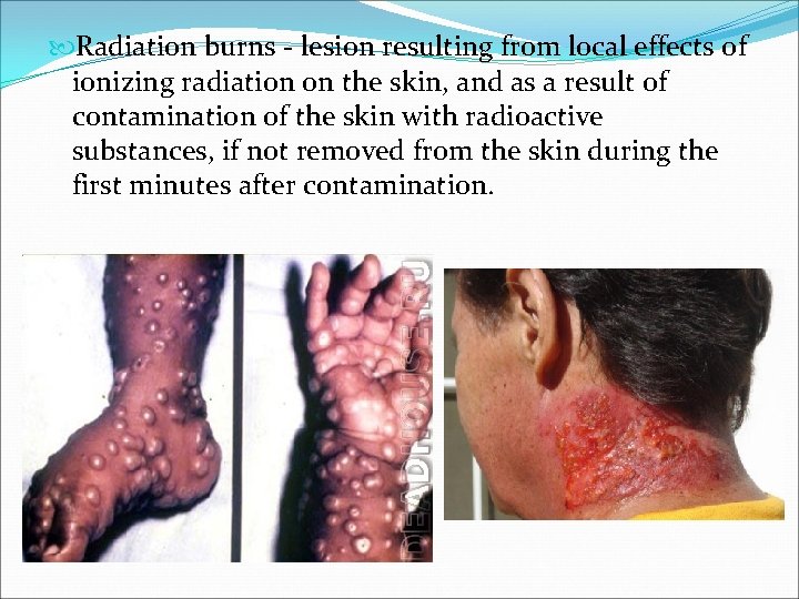  Radiation burns - lesion resulting from local effects of ionizing radiation on the