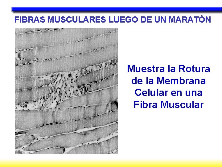 FIBRAS MUSCULARES LUEGO DE UN MARATÓN Muestra la Rotura de la Membrana Celular en