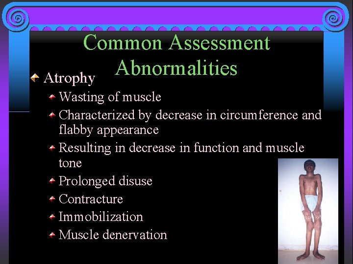 Common Assessment Abnormalities Atrophy Wasting of muscle Characterized by decrease in circumference and flabby