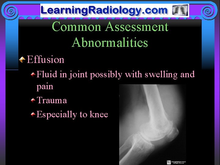 Common Assessment Abnormalities Effusion Fluid in joint possibly with swelling and pain Trauma Especially