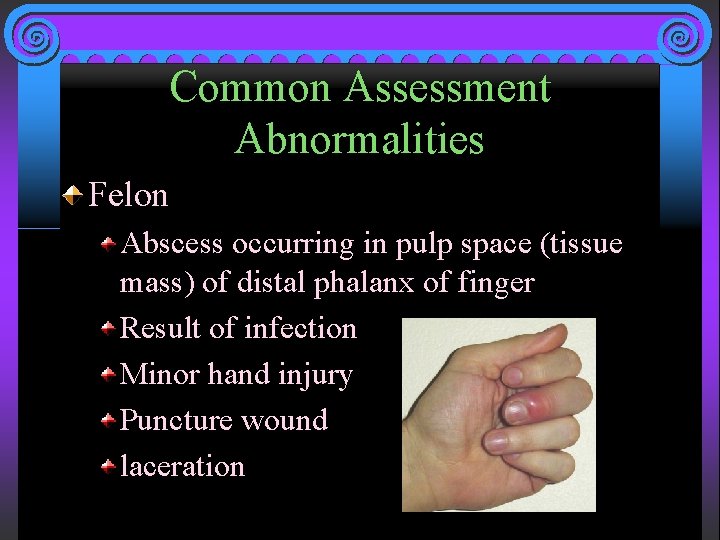 Common Assessment Abnormalities Felon Abscess occurring in pulp space (tissue mass) of distal phalanx