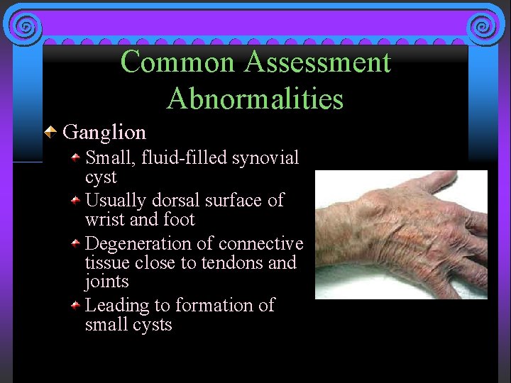 Common Assessment Abnormalities Ganglion Small, fluid-filled synovial cyst Usually dorsal surface of wrist and