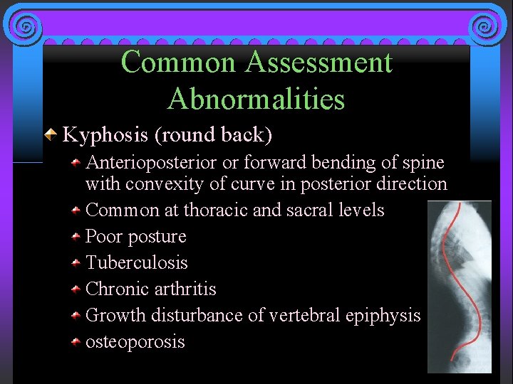 Common Assessment Abnormalities Kyphosis (round back) Anterioposterior or forward bending of spine with convexity