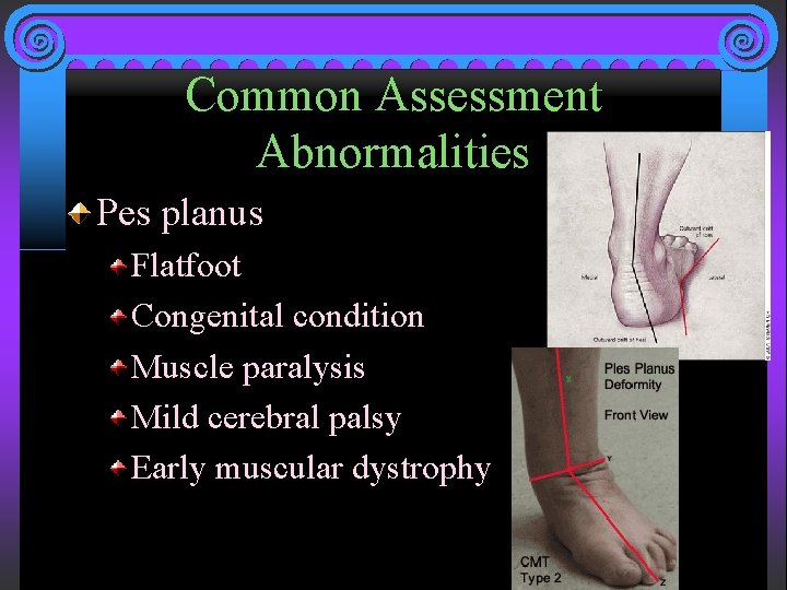 Common Assessment Abnormalities Pes planus Flatfoot Congenital condition Muscle paralysis Mild cerebral palsy Early