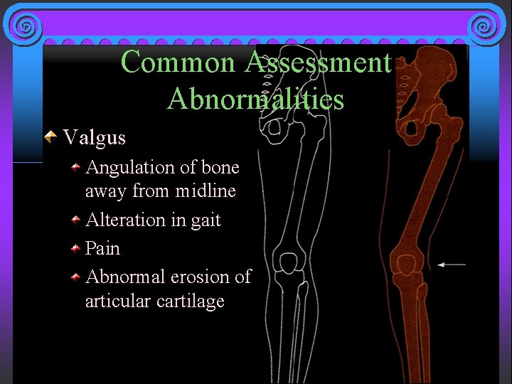 Common Assessment Abnormalities Valgus Angulation of bone away from midline Alteration in gait Pain