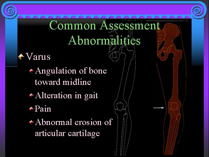 Common Assessment Abnormalities Varus Angulation of bone toward midline Alteration in gait Pain Abnormal