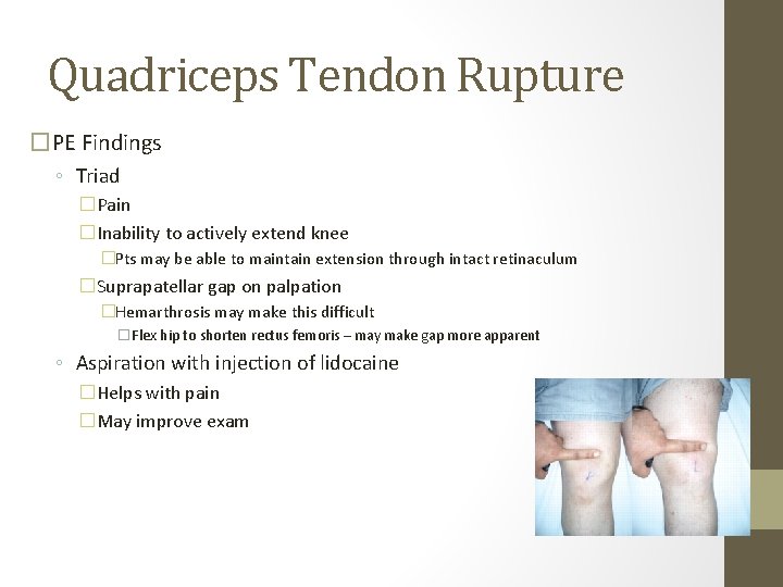 Quadriceps Tendon Rupture �PE Findings ◦ Triad �Pain �Inability to actively extend knee �Pts Quadriceps Tendon Rupture �PE Findings ◦ Triad �Pain �Inability to actively extend knee �Pts