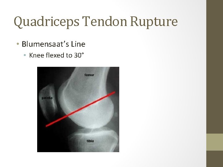Quadriceps Tendon Rupture • Blumensaat’s Line • Knee flexed to 30° Quadriceps Tendon Rupture • Blumensaat’s Line • Knee flexed to 30°
